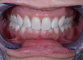 Bleaching — Nachher-Aufnahme