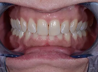 Bleaching — Vorher-Aufnahme