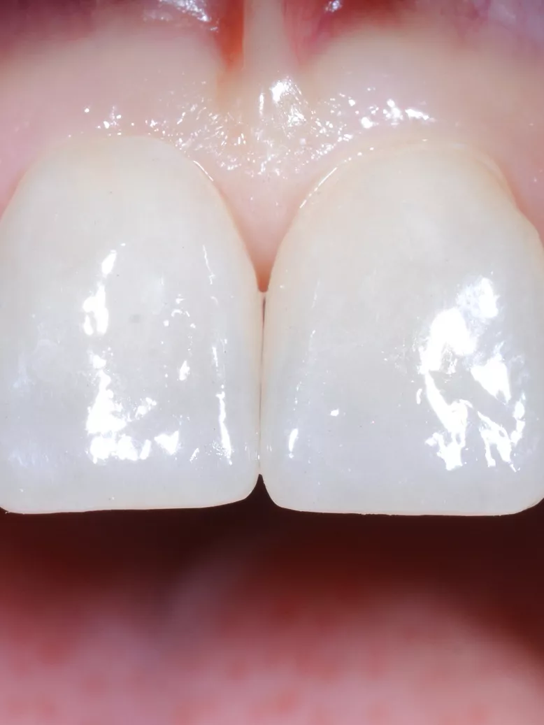 Detailaufnahme ästhetischer Zahnversorgung mit Veneers