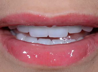 Veneers — Nachher-Aufnahme