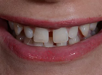 Veneers — Vorher-Aufnahme